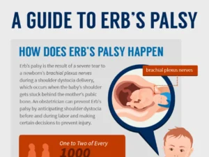 History Of Erb’s Palsy Symptoms And Treatment